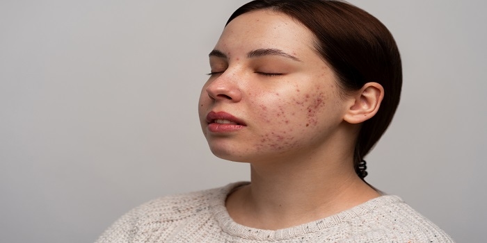 Sering Disangka Sama, Ini Bedanya Rosacea dan Jerawat yang Perlu Diketahui